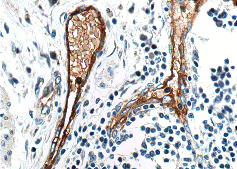 Immunohistochemistry of paraffin-embedded human colon cancer tissue slide using Catalog No:115943(ANTXR1 Antibody) at dilution of 1:200 (under 40x lens).