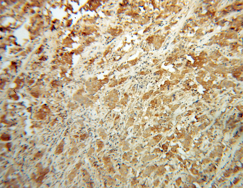 Immunohistochemical of paraffin-embedded human prostate cancer using Catalog No:113084(NDUFS6 antibody) at dilution of 1:100 (under 10x lens)