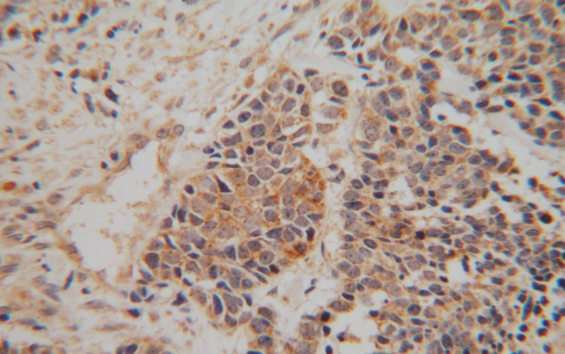 Immunohistochemical of paraffin-embedded human lung cancer using Catalog No:113062(NDUFA6 antibody) at dilution of 1:100 (under 40x lens)