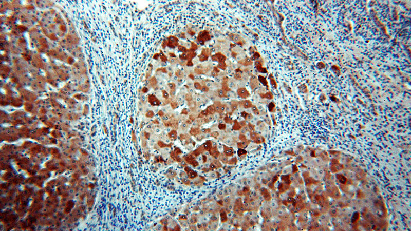 Immunohistochemical of paraffin-embedded human hepatocirrhosis using Catalog No:111326(H6PD antibody) at dilution of 1:100 (under 10x lens)
