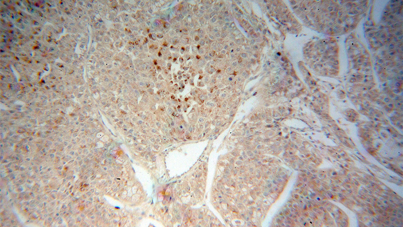 Immunohistochemical of paraffin-embedded human liver cancer using Catalog No:109577(CROT antibody) at dilution of 1:100 (under 10x lens)