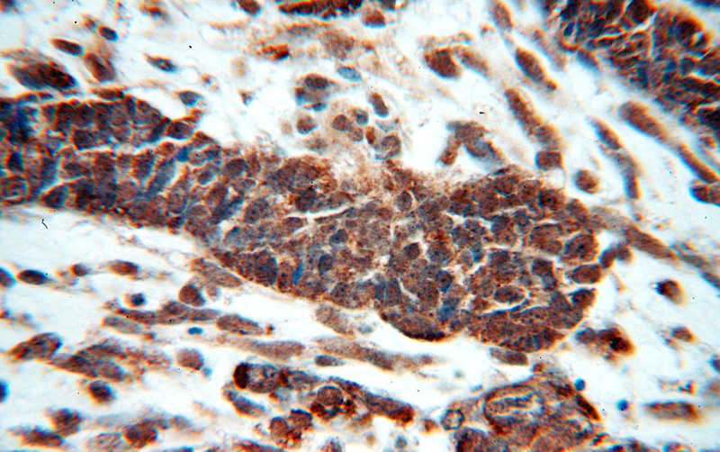 Immunohistochemical of paraffin-embedded human ovary tumor using Catalog No:111375(HDAC3 antibody) at dilution of 1:50 (under 40x lens)