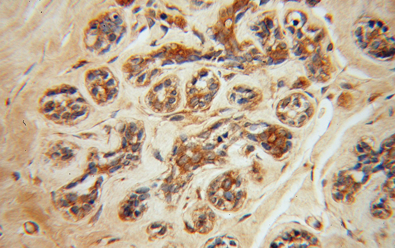 Immunohistochemical of paraffin-embedded human breast cancer using Catalog No:113036(NCK1 antibody) at dilution of 1:100 (under 40x lens)