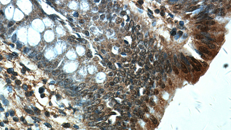 Immunohistochemical of paraffin-embedded human colon using Catalog No:113968(PLK1-phospho antibody) at dilution of 1:50 (under 40x lens)