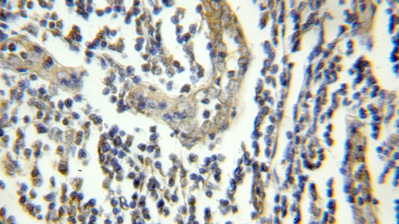Immunohistochemical of paraffin-embedded human lymphoma using Catalog No:110640(FGFR1OP antibody) at dilution of 1:50 (under 10x lens)