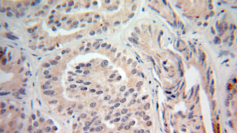 Immunohistochemical of paraffin-embedded human prostate cancer using Catalog No:116325(TRIM9 antibody) at dilution of 1:100 (under 25x lens)