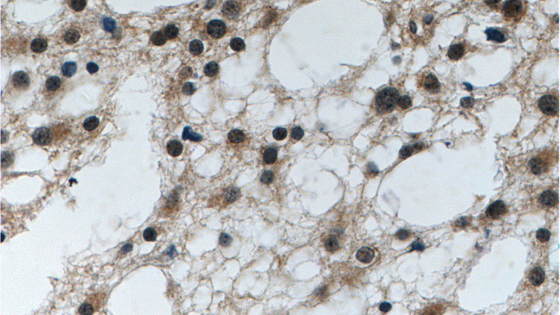 Immunohistochemistry of paraffin-embedded human gliomas tissue slide using Catalog No:114226(PrP Antibody) at dilution of 1:200 (under 40x lens)