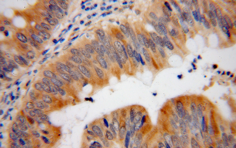 Immunohistochemical of paraffin-embedded human colon cancer using Catalog No:115027(SDCCAG3 antibody) at dilution of 1:50 (under 40x lens)