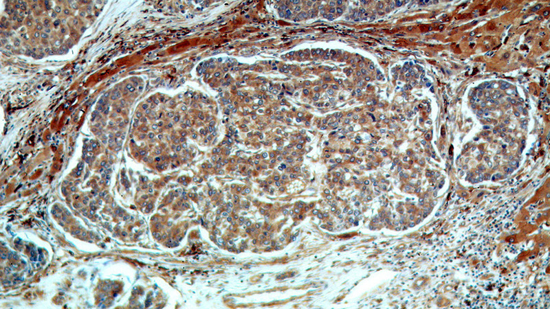 Immunohistochemical of paraffin-embedded human liver cancer using Catalog No:115192(SERINC1 antibody) at dilution of 1:50 (under 10x lens)