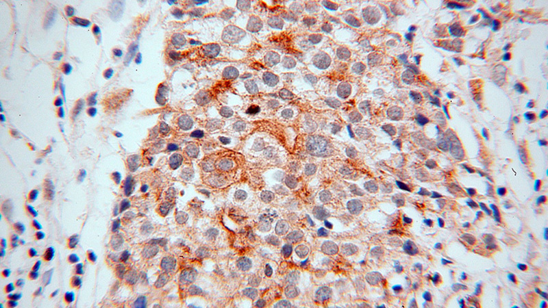 Immunohistochemical of paraffin-embedded human ovary tumor using Catalog No:110321(ENOX2 antibody) at dilution of 1:100 (under 40x lens)