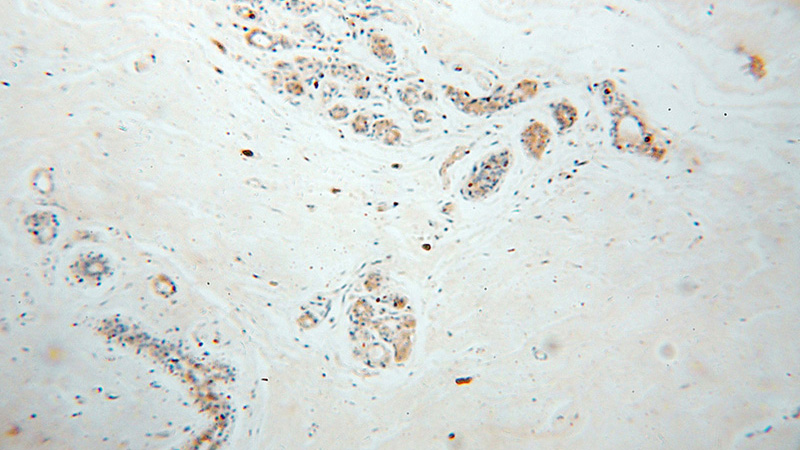 Immunohistochemical of paraffin-embedded human colon cancer using Catalog No:108845(CAPZA2 antibody) at dilution of 1:50 (under 10x lens)
