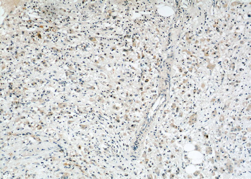 Immunohistochemical of paraffin-embedded human breast cancer using Catalog No:115805(SYTL2 antibody) at dilution of 1:50 (under 10x lens)