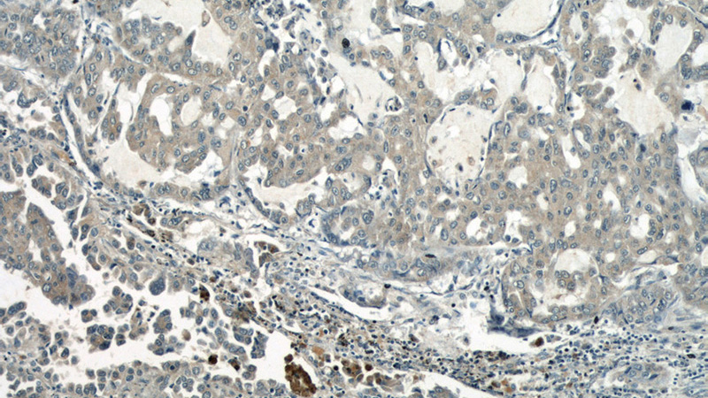 Immunohistochemical of paraffin-embedded human lung cancer using Catalog No:114777(RocK1 antibody) at dilution of 1:50 (under 10x lens)