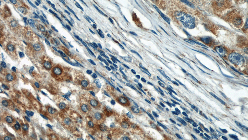 Immunohistochemical of paraffin-embedded human liver cancer using Catalog No:114216(PHB antibody) at dilution of 1:50 (under 40x lens)