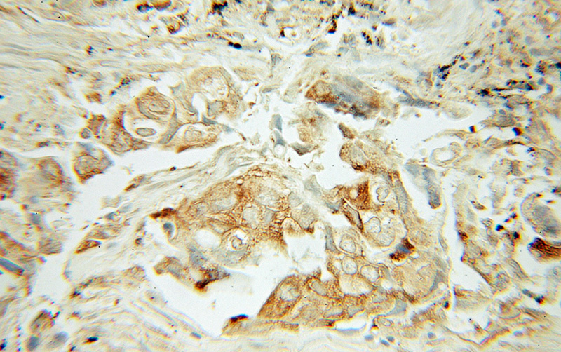 Immunohistochemical of paraffin-embedded human lung cancer using Catalog No:113427(OS9 antibody) at dilution of 1:50 (under 10x lens)