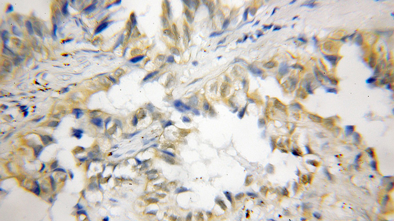 Immunohistochemical of paraffin-embedded human lung cancer using Catalog No:116303(TRIM21 antibody) at dilution of 1:50 (under 10x lens)