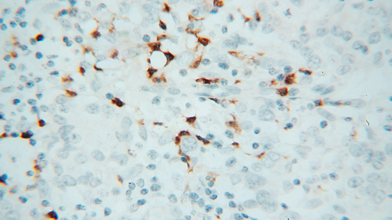 Immunohistochemical of paraffin-embedded human breast cancer using Catalog No:113852(PRKCI antibody) at dilution of 1:100 (under 40x lens)