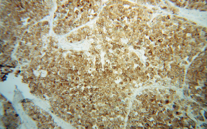 Immunohistochemical of paraffin-embedded human liver cancer using Catalog No:111151(GPX7 antibody) at dilution of 1:100 (under 10x lens)