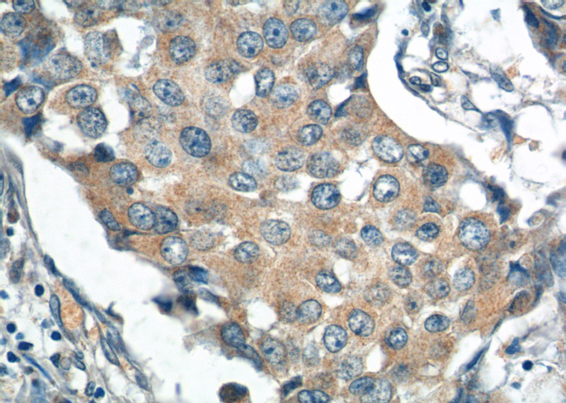 Immunohistochemistry of paraffin-embedded human breast cancer tissue slide using Catalog No:114133(PPM1B Antibody) at dilution of 1:200 (under 40x lens)
