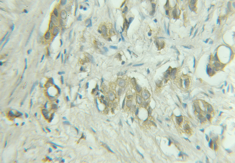 Immunohistochemical of paraffin-embedded human prostate cancer using Catalog No:114463(RAB9A antibody) at dilution of 1:50 (under 10x lens)