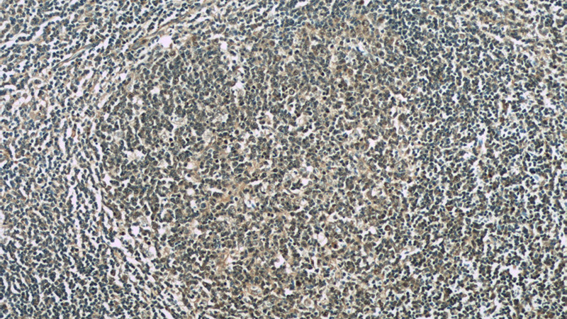 Immunohistochemistry of paraffin-embedded human tonsillitis slide using Catalog No:116016(TFPT Antibody) at dilution of 1:50