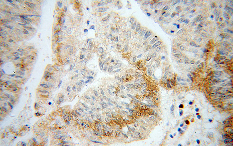 Immunohistochemical of paraffin-embedded human liver cancer using Catalog No:109755(DCP1B antibody) at dilution of 1:100 (under 40x lens)