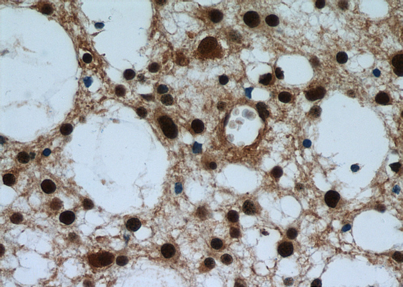 Immunohistochemical of paraffin-embedded human gliomas using Catalog No:116726(VCP antibody) at dilution of 1:50 (under 40x lens)