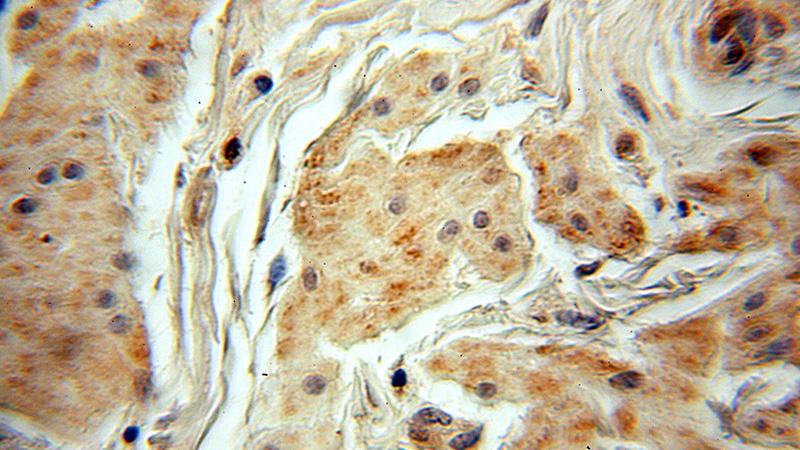 Immunohistochemical of paraffin-embedded human ovary tumor using Catalog No:112924(MYEOV antibody) at dilution of 1:50 (under 10x lens)