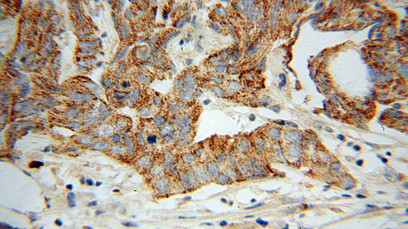 Immunohistochemical of paraffin-embedded human prostate cancer using Catalog No:114733(RND2 antibody) at dilution of 1:50 (under 40x lens)