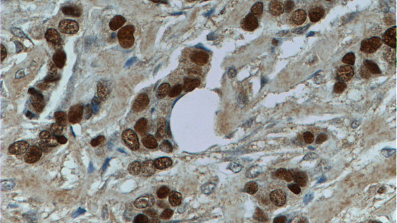 Immunohistochemistry of paraffin-embedded human breast cancer tissue slide using Catalog No:109096(CDC25A Antibody) at dilution of 1:50 (under 40x lens)