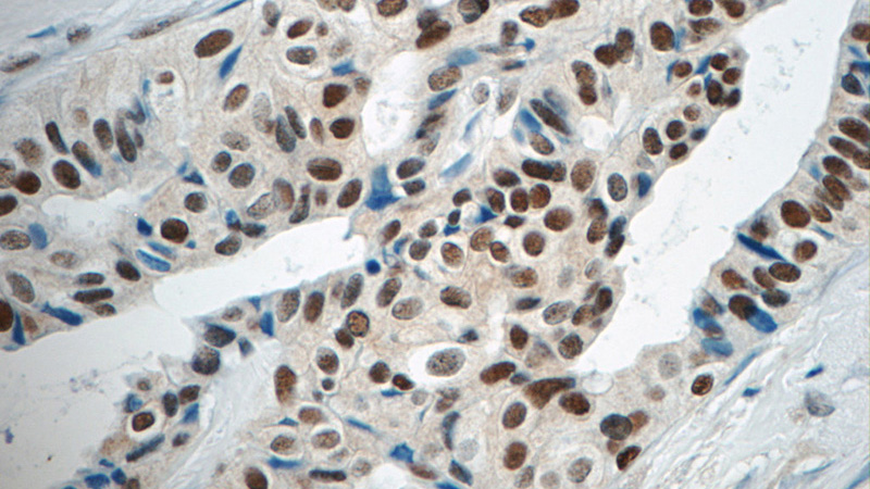 Immunohistochemistry of paraffin-embedded human breast cancer tissue slide using Catalog No:110881(GATA3 Antibody) at dilution of 1:50 (under 40x lens)