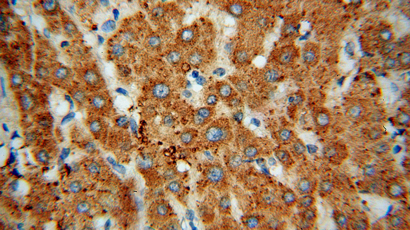 Immunohistochemical of paraffin-embedded human liver cancer using Catalog No:107723(ACADVL antibody) at dilution of 1:50 (under 40x lens)