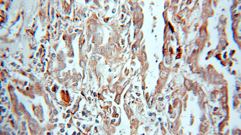 Immunohistochemical of paraffin-embedded human lung cancer using Catalog No:110120(DUSP22 antibody) at dilution of 1:10 (under 10x lens)
