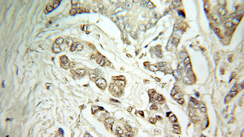 Immunohistochemical of paraffin-embedded human breast cancer using Catalog No:108285(ATF4 antibody) at dilution of 1:100 (under 10x lens)