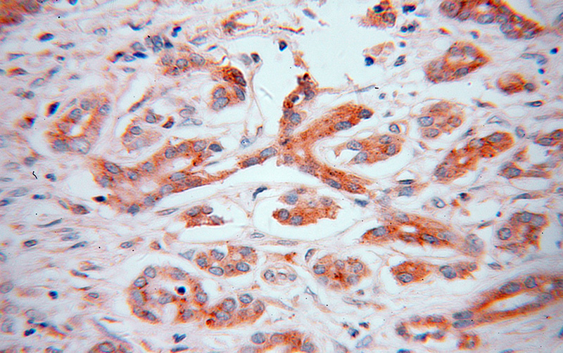 Immunohistochemical of paraffin-embedded human pancreas cancer using Catalog No:110767(GAA antibody) at dilution of 1:50 (under 40x lens)