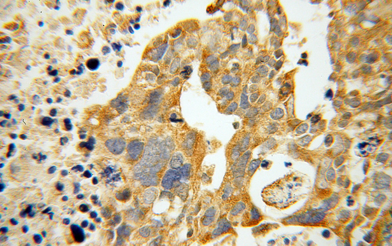 Immunohistochemical of paraffin-embedded human ovary tumor using Catalog No:108337(ATP11B antibody) at dilution of 1:100 (under 40x lens)