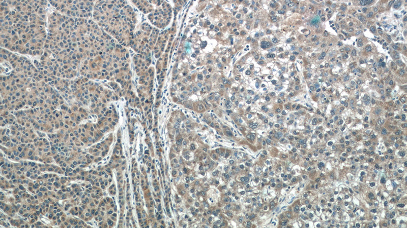Immunohistochemistry of paraffin-embedded human liver cancer tissue slide using Catalog No:111760(IMP5 Antibody) at dilution of 1:50 (under 10x lens)
