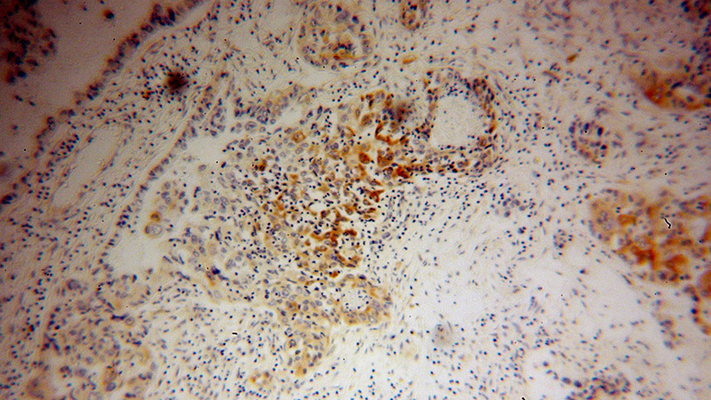 Immunohistochemical of paraffin-embedded human pancreas cancer using Catalog No:110310(EEF1A1 antibody) at dilution of 1:100 (under 10x lens)