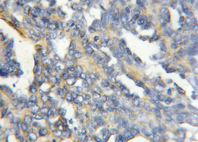 Immunohistochemical of paraffin-embedded human ovary tumor using Catalog No:117309(COX4I2 antibody) at dilution of 1:50 (under 10x lens)