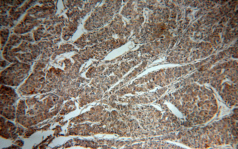 Immunohistochemical of paraffin-embedded human liver cancer using Catalog No:113611(PXN antibody) at dilution of 1:50 (under 10x lens)