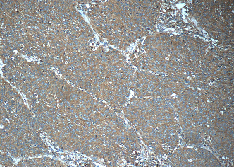 Immunohistochemistry of paraffin-embedded human lung cancer tissue slide using Catalog No:113856(PKLR Antibody) at dilution of 1:50 (under 10x lens)