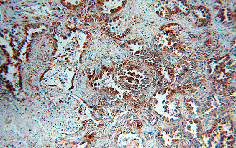 Immunohistochemical of paraffin-embedded human lung cancer using Catalog No:107512(RRM1 antibody) at dilution of 1:100 (under 10x lens)