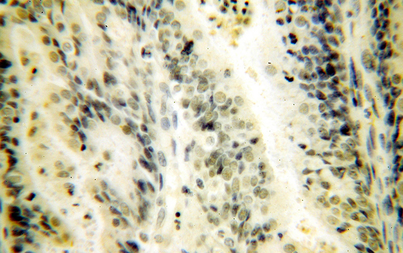 Immunohistochemical of paraffin-embedded human endometrial cancer using Catalog No:109527(CPSF4 antibody) at dilution of 1:50 (under 40x lens)