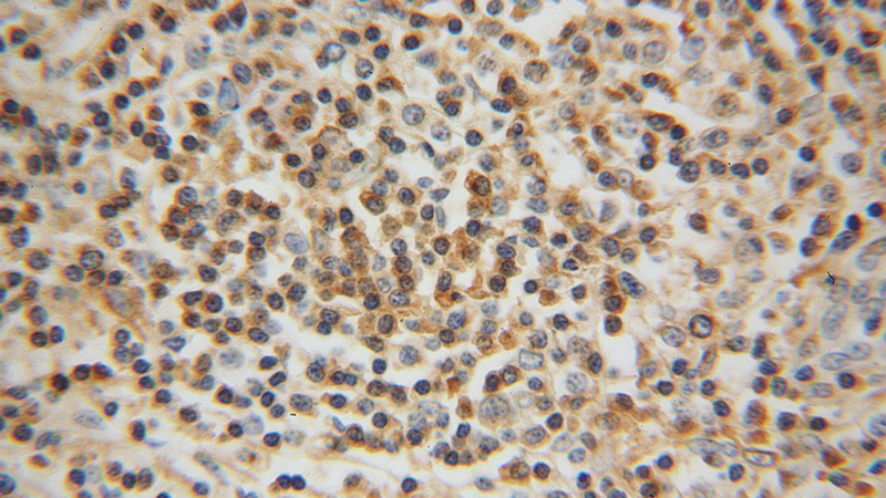 Immunohistochemical of paraffin-embedded human lymphoma using Catalog No:114694(RIAM,APBB1IP antibody) at dilution of 1:100 (under 40x lens)