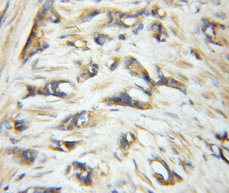 Immunohistochemical of paraffin-embedded human prostate cancer using Catalog No:110270(EIF6 antibody) at dilution of 1:50 (under 10x lens)