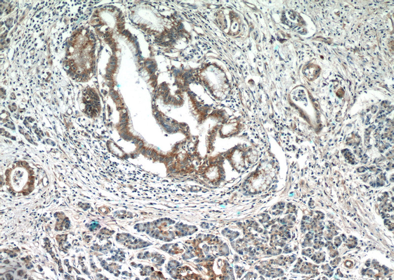 Immunohistochemistry of paraffin-embedded human pancreas cancer tissue slide using Catalog No:115648(SPRY2 Antibody) at dilution of 1:50 (under 10x lens)