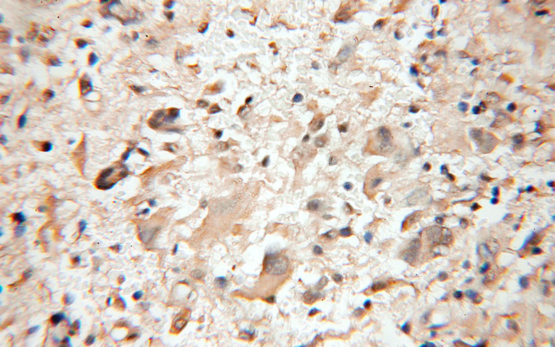 Immunohistochemical of paraffin-embedded human gliomas using Catalog No:114334(PTS antibody) at dilution of 1:50 (under 10x lens)