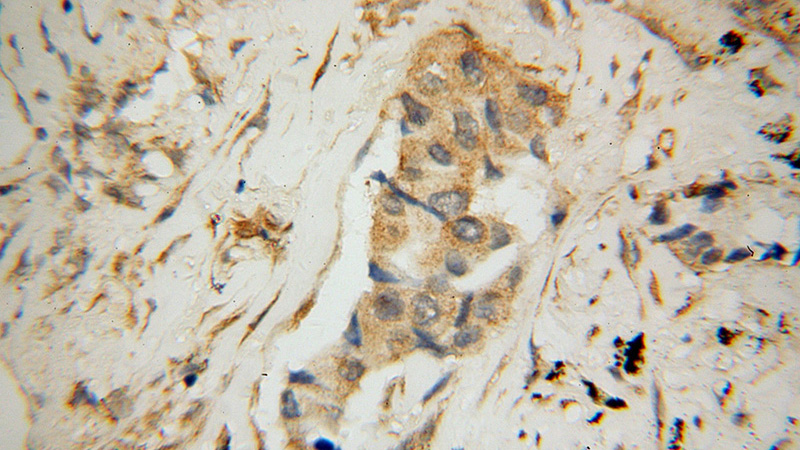 Immunohistochemical of paraffin-embedded human lung cancer using Catalog No:112015(KIF4A antibody) at dilution of 1:50 (under 40x lens)