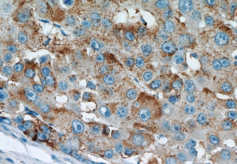 Immunohistochemical of paraffin-embedded human liver cancer using Catalog No:116827(Willin antibody) at dilution of 1:50 (under 40x lens)