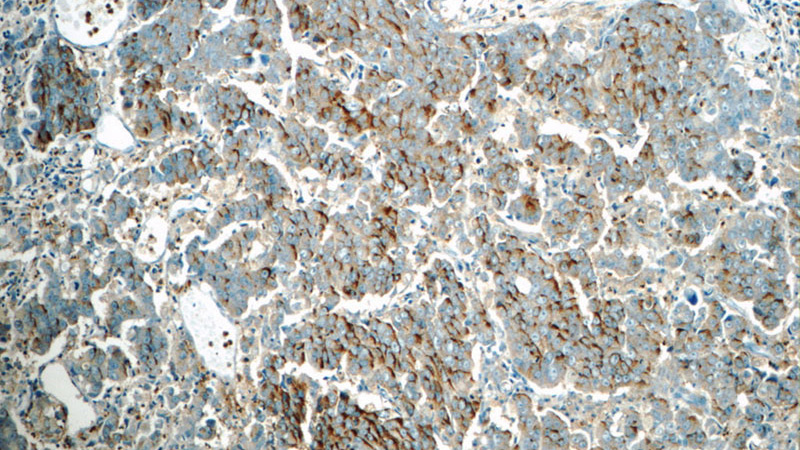Immunohistochemistry of paraffin-embedded human prostate cancer tissue slide using Catalog No:114444(RAB3D Antibody) at dilution of 1:50 (under 10x lens)